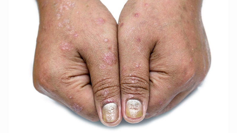 Nail Psoriasis And Psoriatic Arthritis (clinical And Genetic Links)